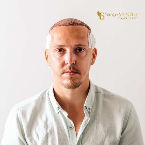 After Hair Transplantation, What Should Be Considered?