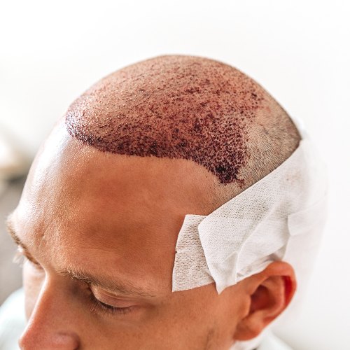 First Washing Procedure After Hair Transplantation
